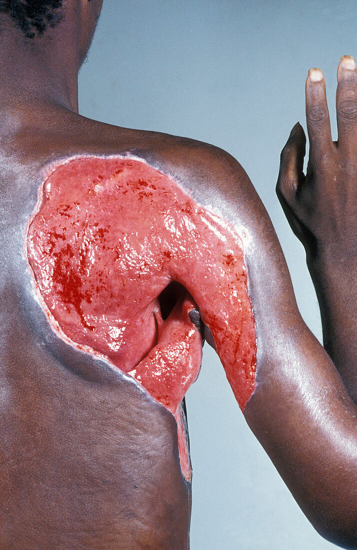 Tissue necrosis in HIV patient