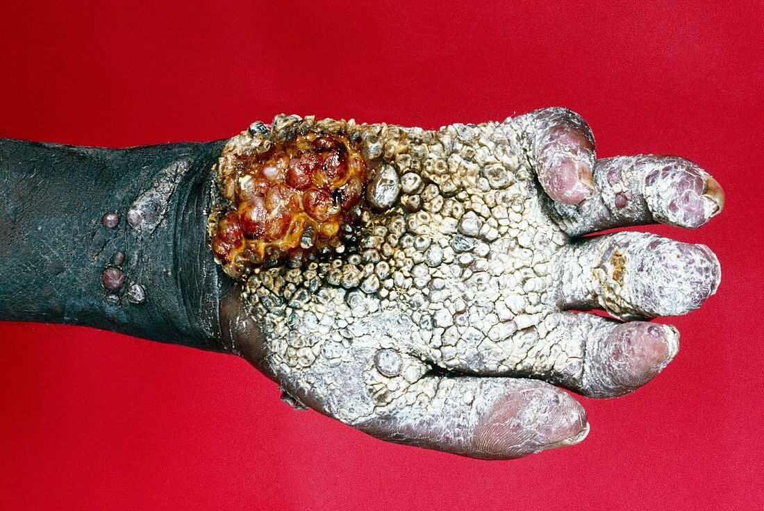 Kaposi's sarcoma in an AIDS patient