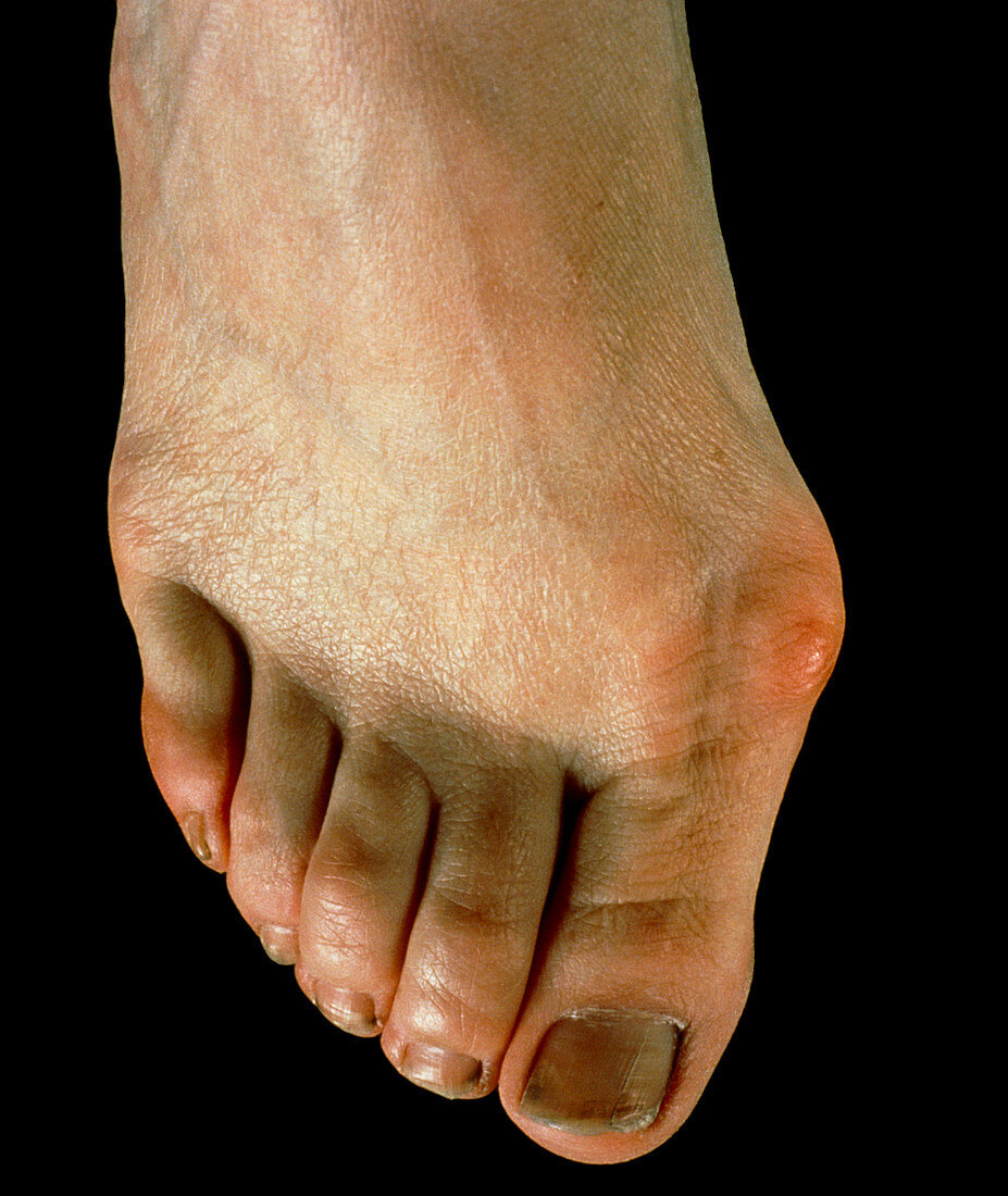 Bunion