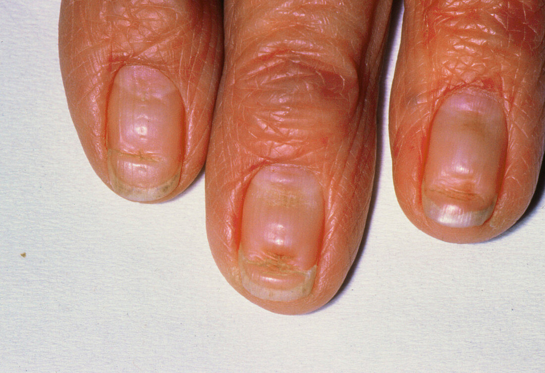 Beau's lines occurring on three fingernails