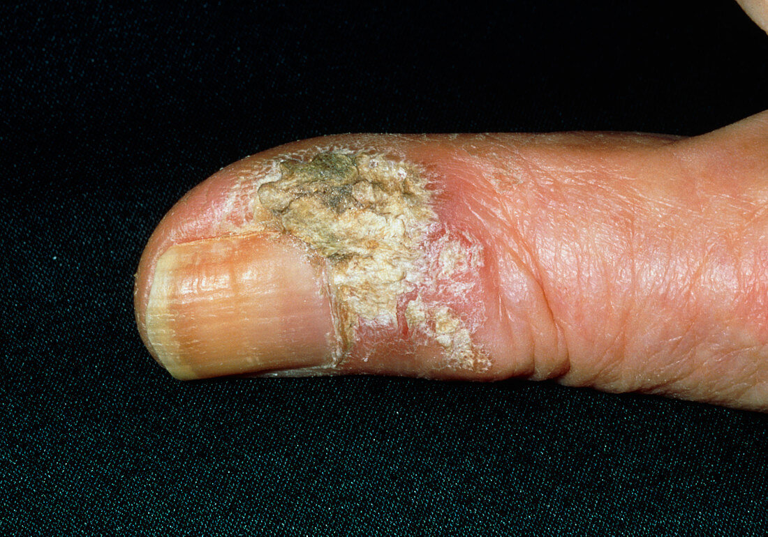 Scaly lesion on thumb due to Bowen's disease