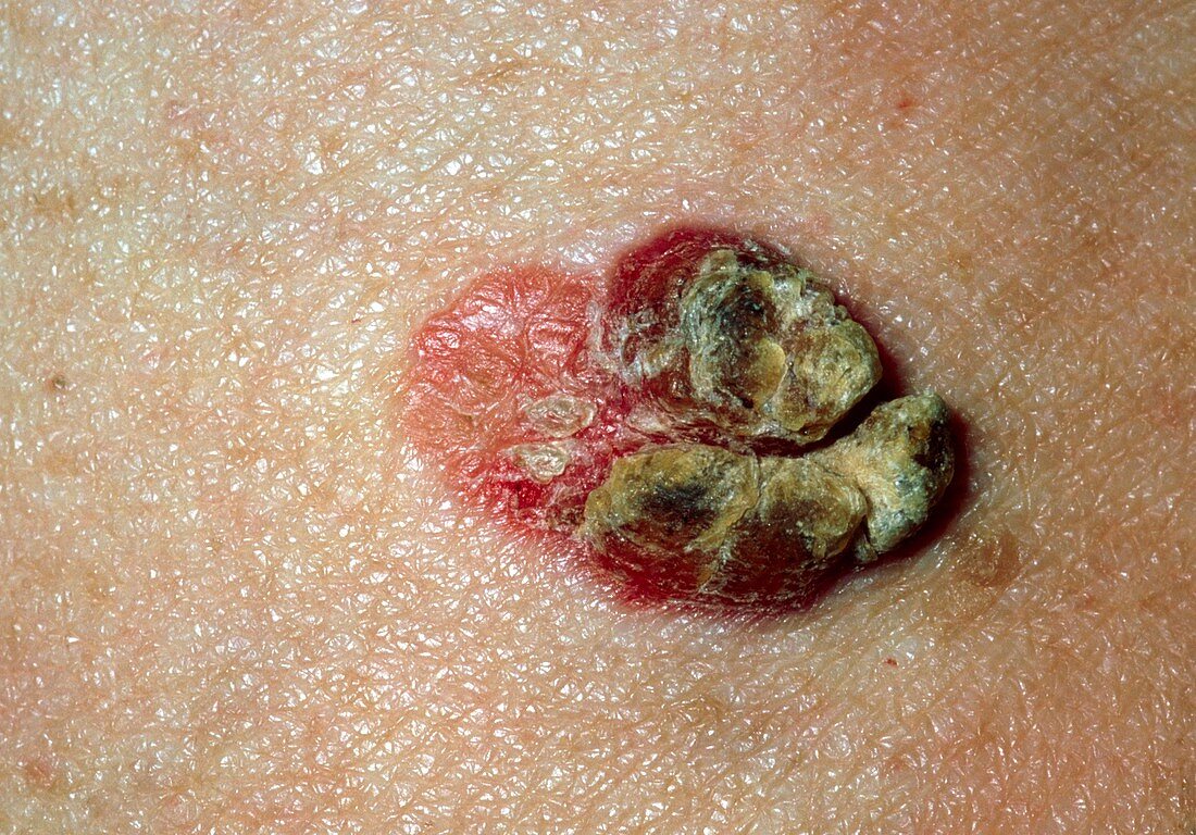Skin carcinoma in Bowen's disease