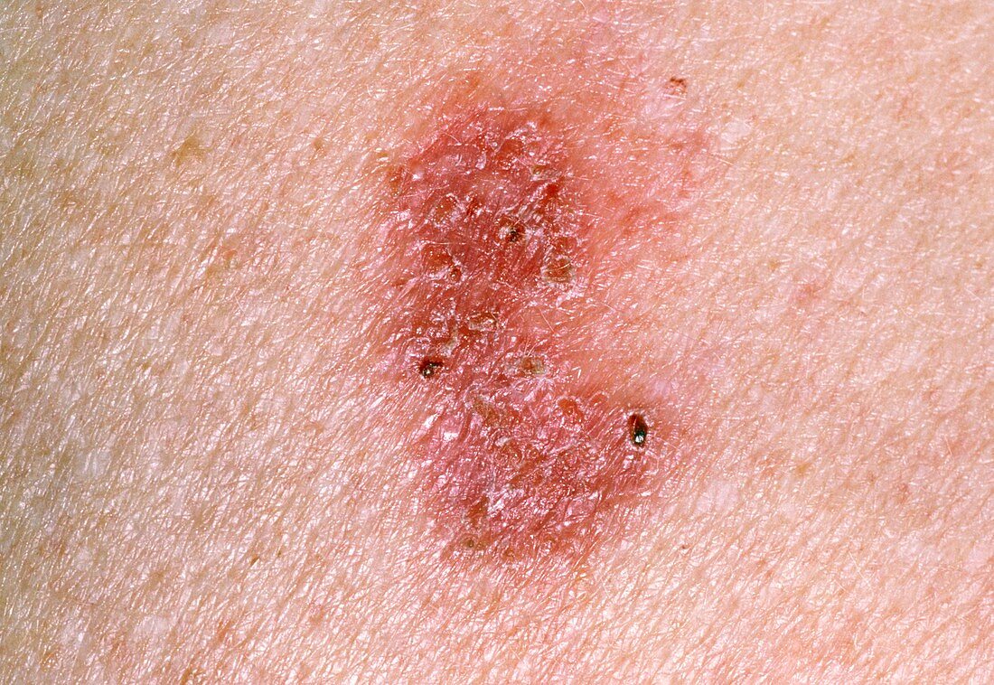 Close-up of skin lesion due to Bowen's disease