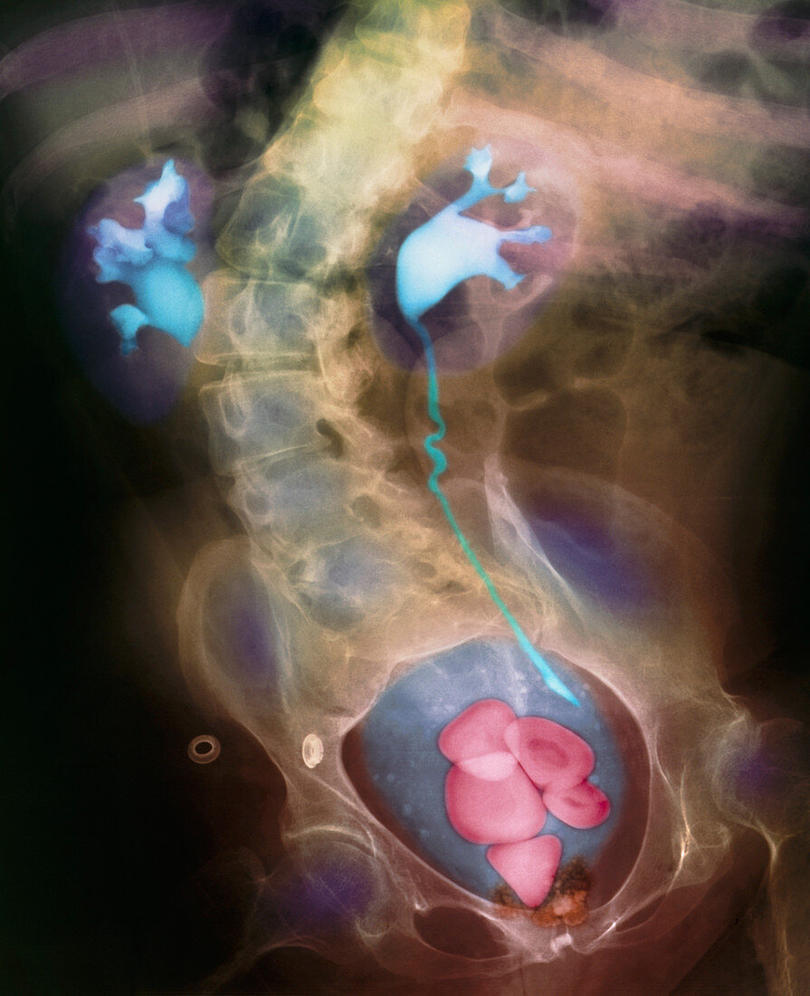 Coloured X-ray showing bladder stones