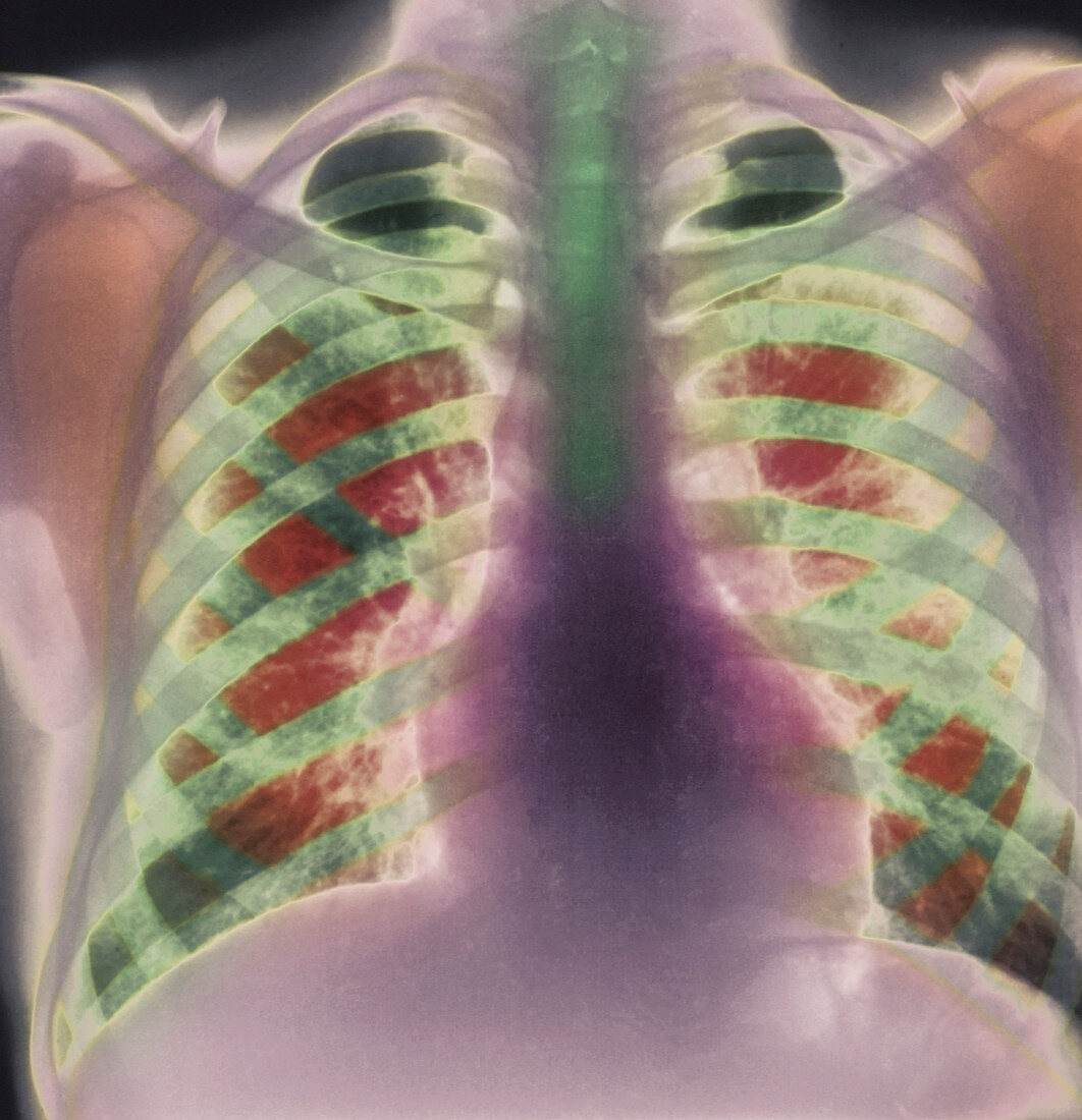 Chronic bronchitis,X-ray