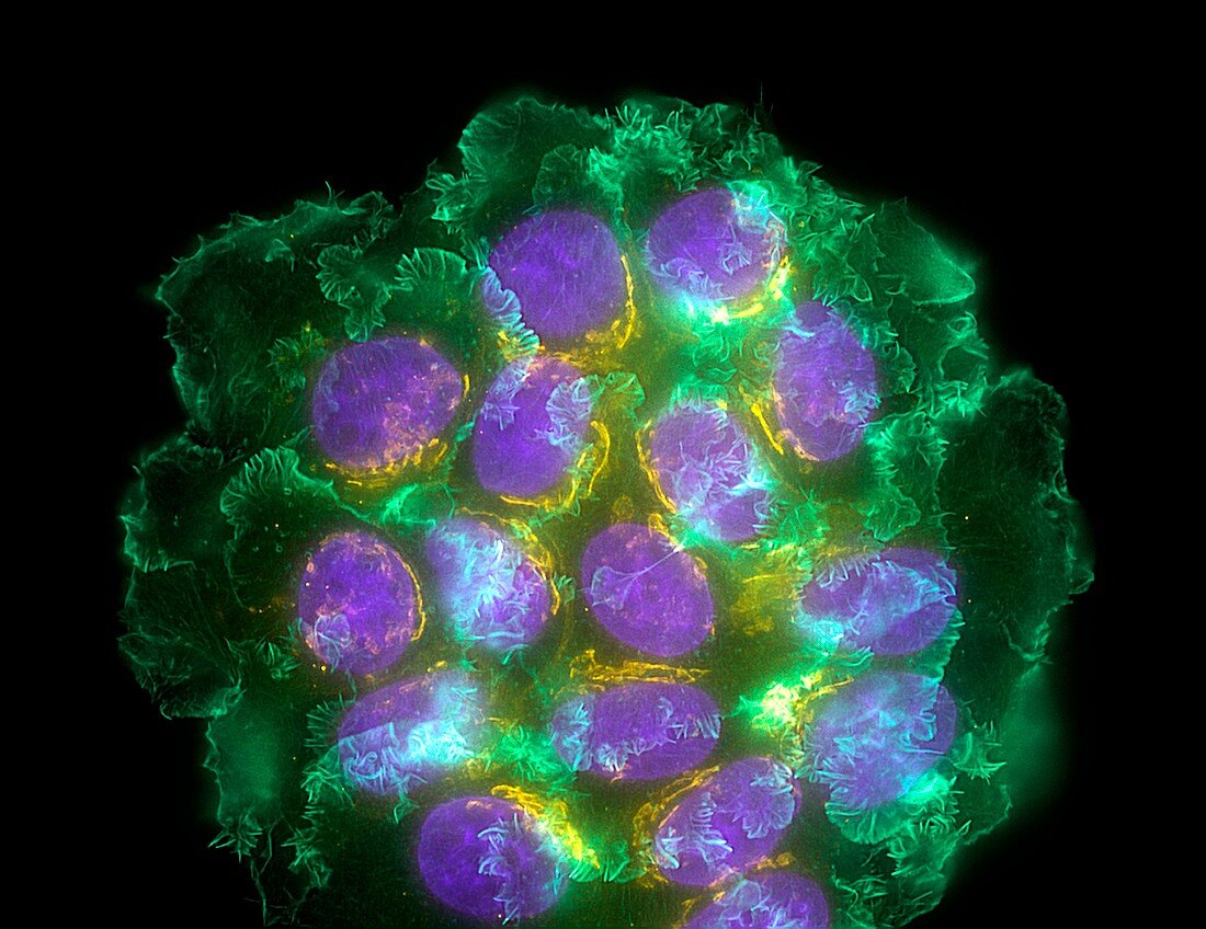 Breast cancer cells,light micrograph