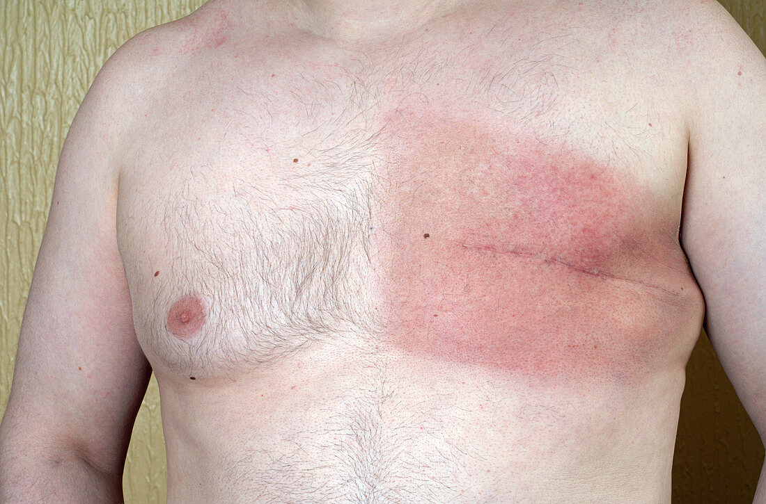 Male breast cancer treatment