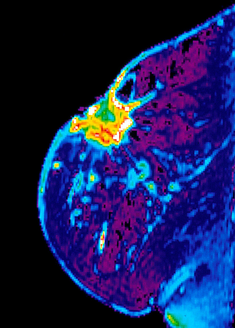 Breast cancer,MRI scan