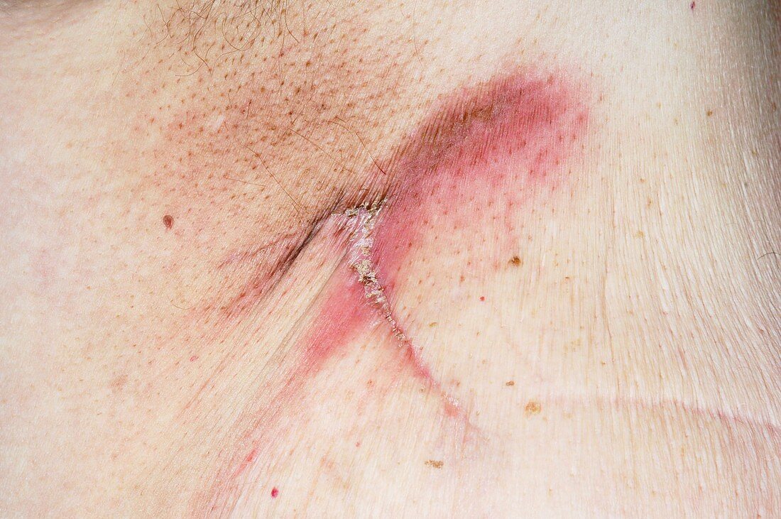 Inflamed breast cancer scar