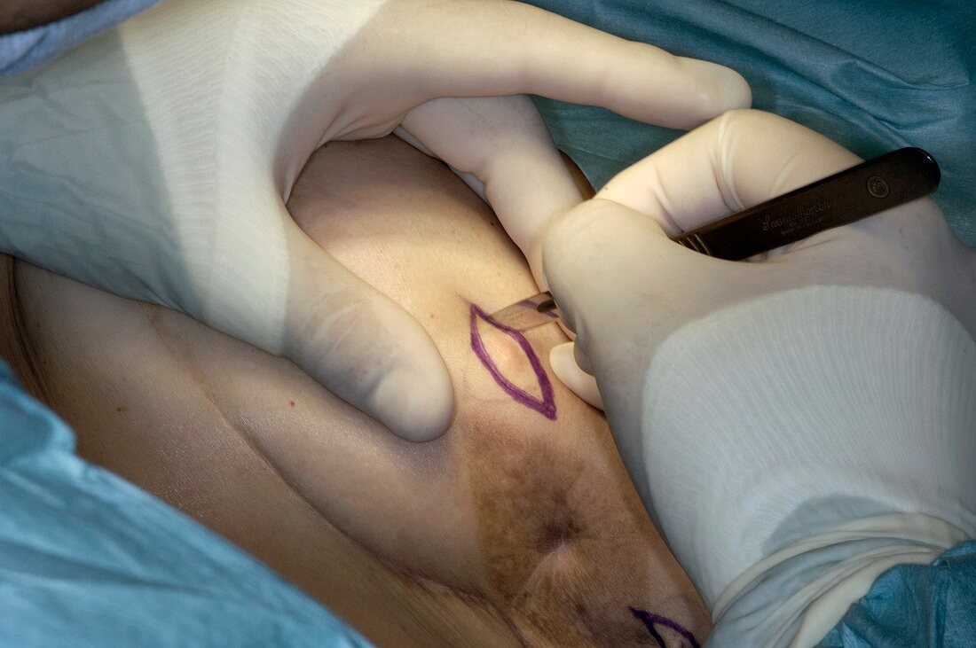 Breast cancer surgery