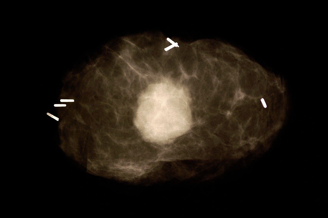 Breast cancer,X-ray image