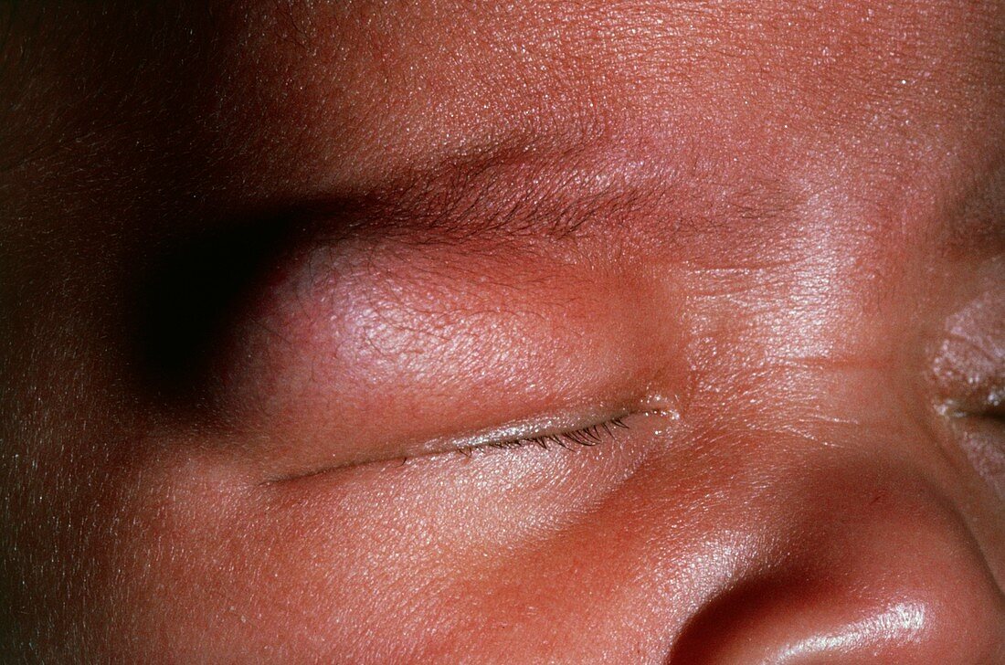Dermoid cyst on an infant's eyelid