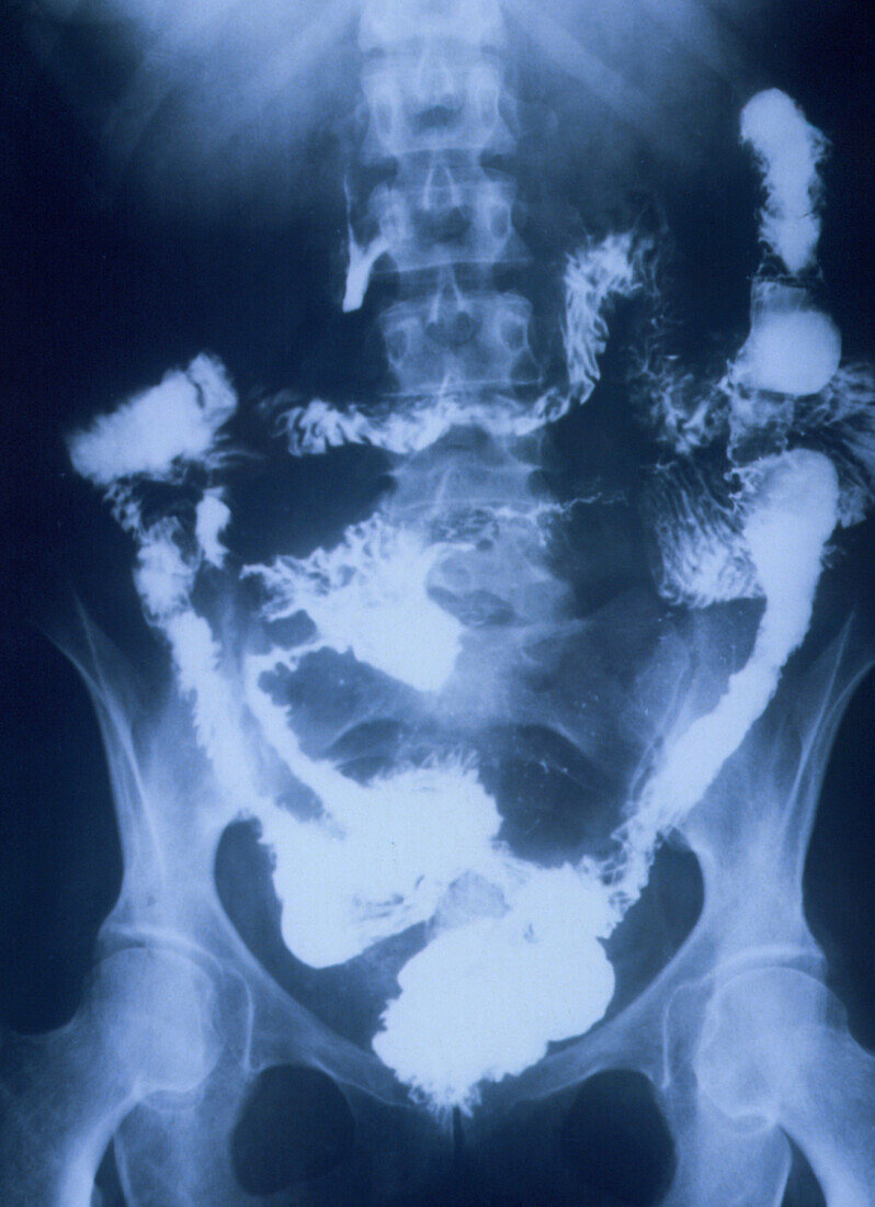 X-ray of the lower gut in Crohn's disease