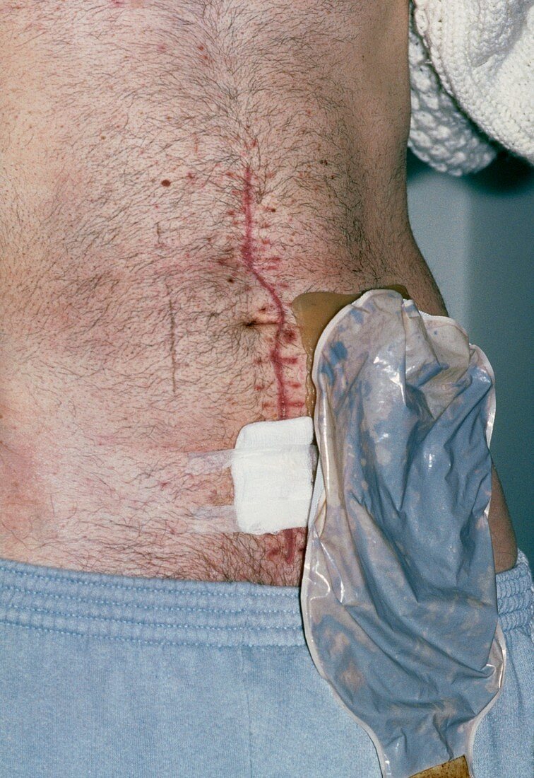 Patient after abdomen surgery