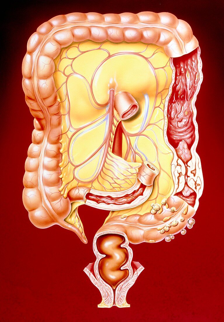 Artwork of Crohn's disease,colitis,colon cancer