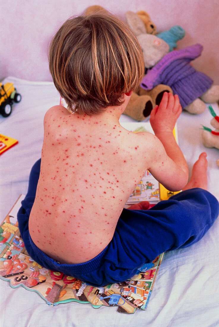 Young boy affected by a severe form of chickenpox