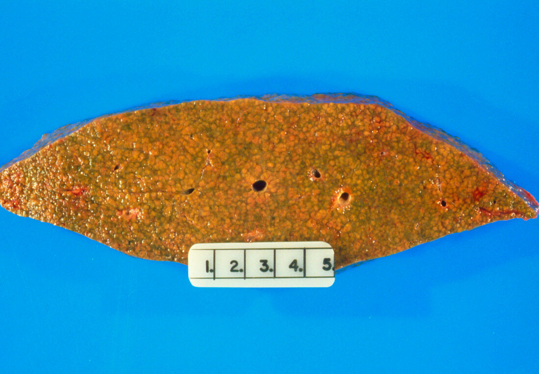 Sectioned human liver showing alcoholic cirrhosis