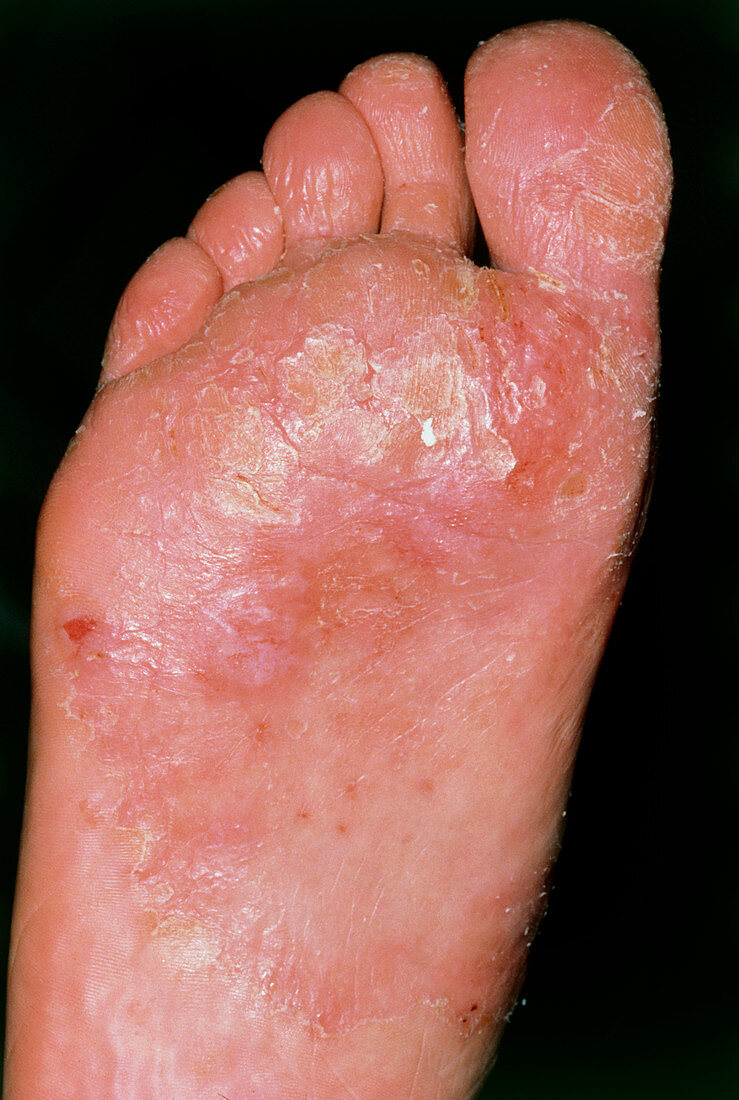 The sole of a foot affected by candidiasis