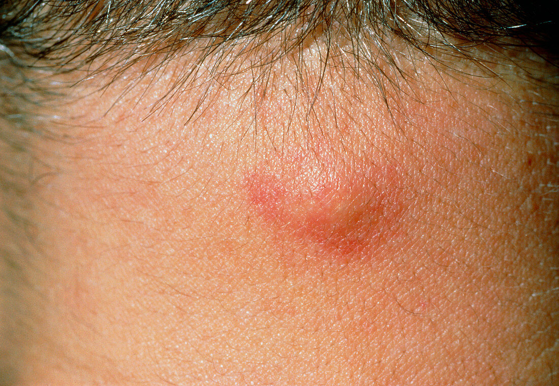 Close Up Inflamed Sebaceous Cyst On … Bild Kaufen 11836111 Science