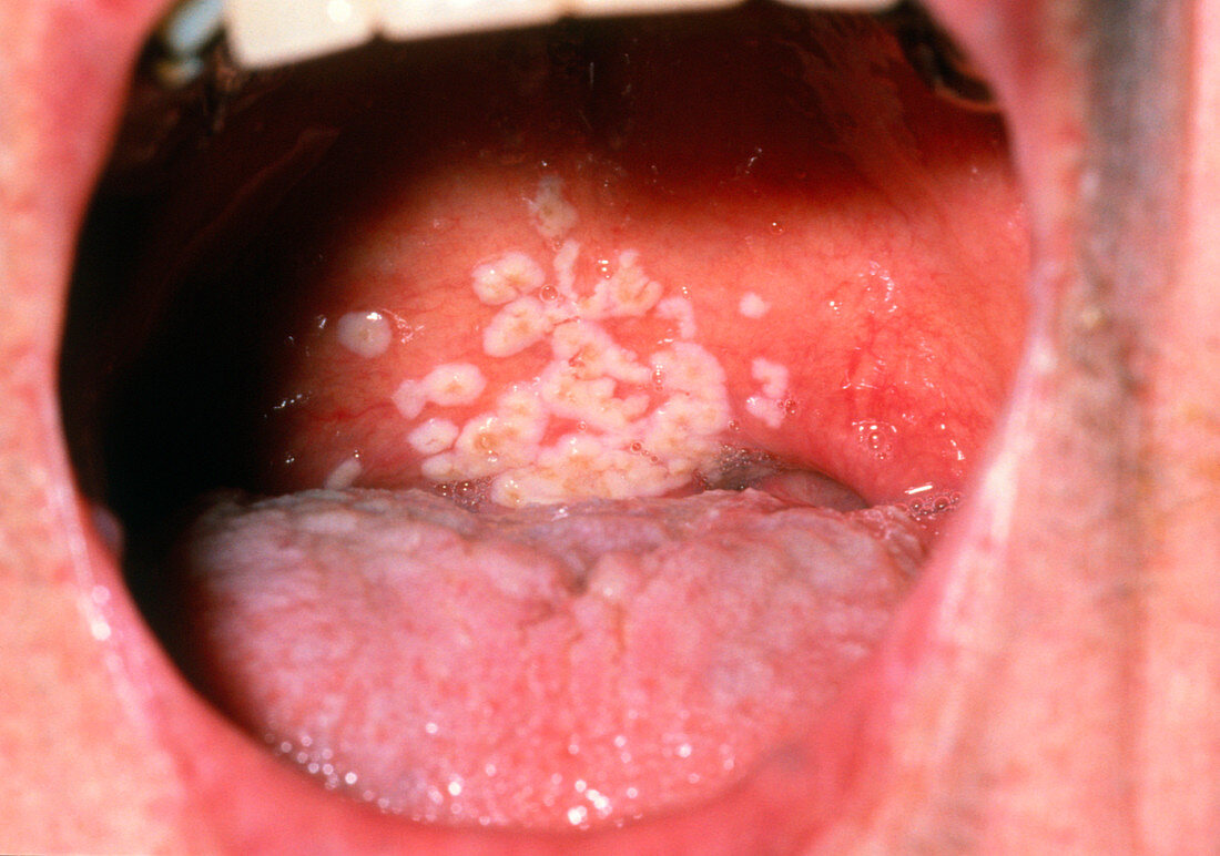 Oral thrush (candidiasis)