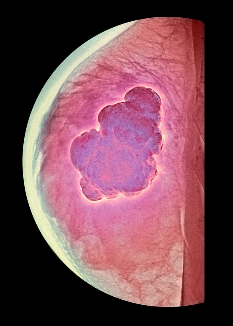 Breast tumour,X-ray