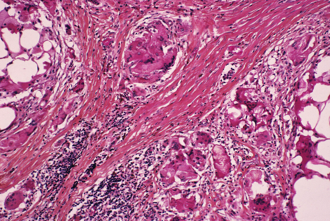 Breast fat cell death