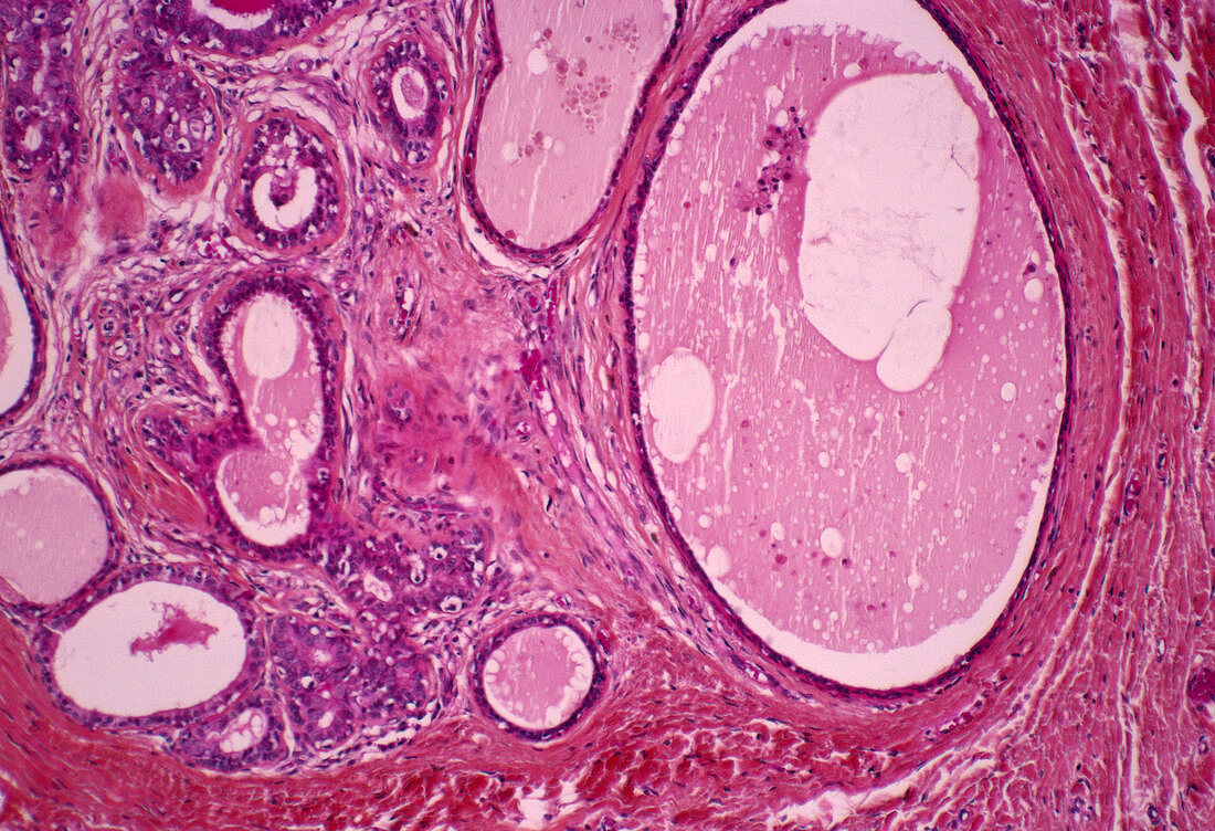 Breast hypertrophy,light micrograph