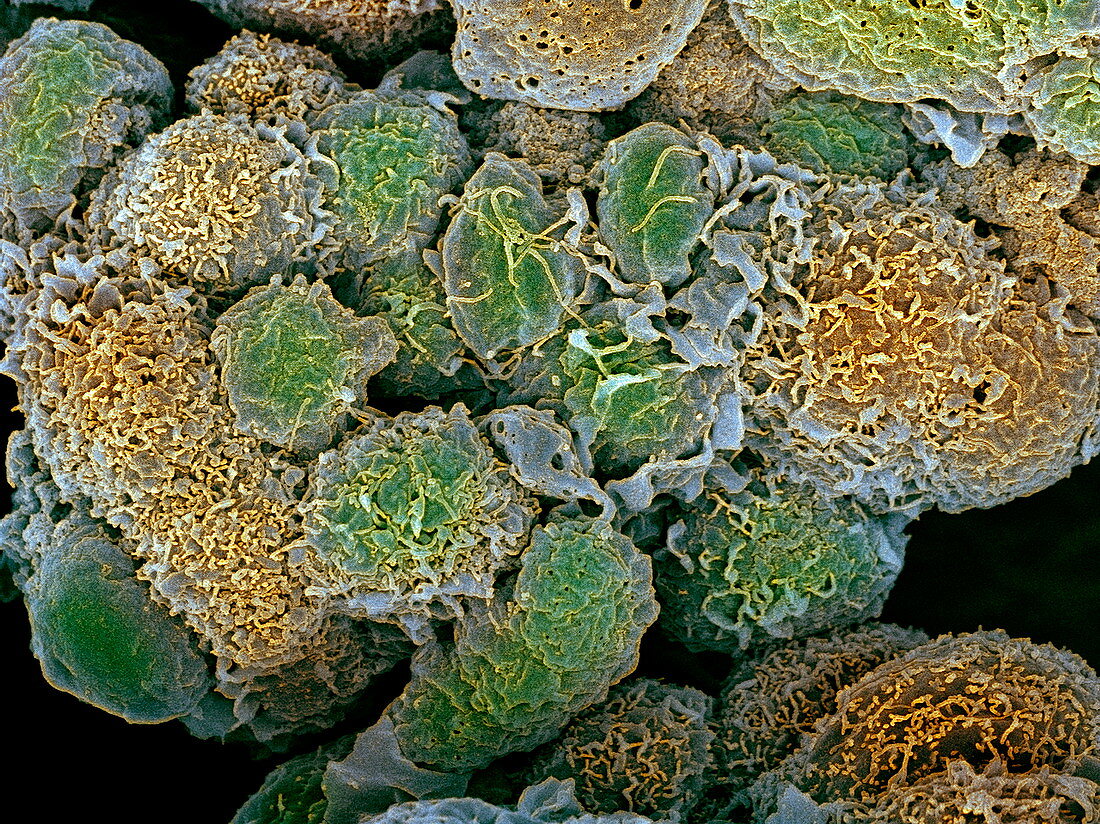 Breast cancer cells,SEM