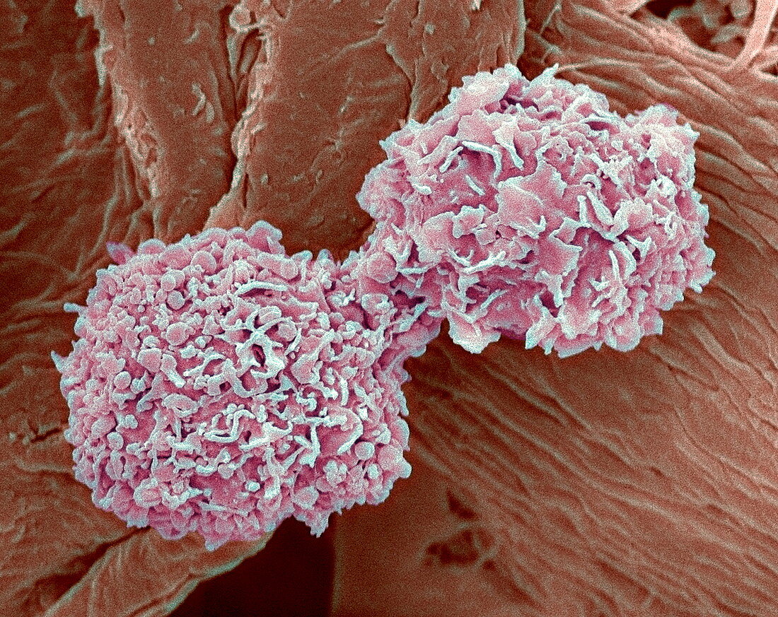 Breast cancer cells,SEM