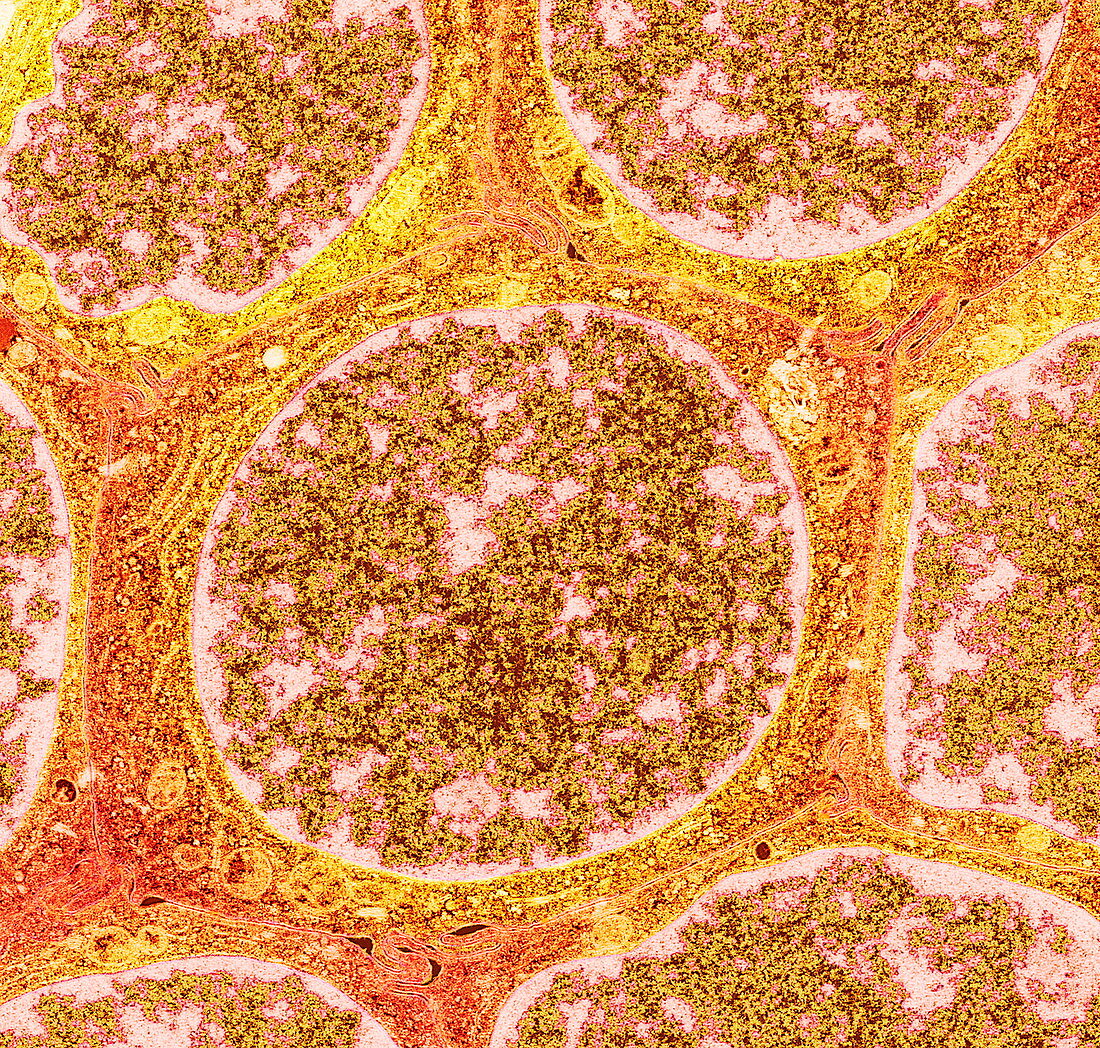 Benign breast disease cells,TEM