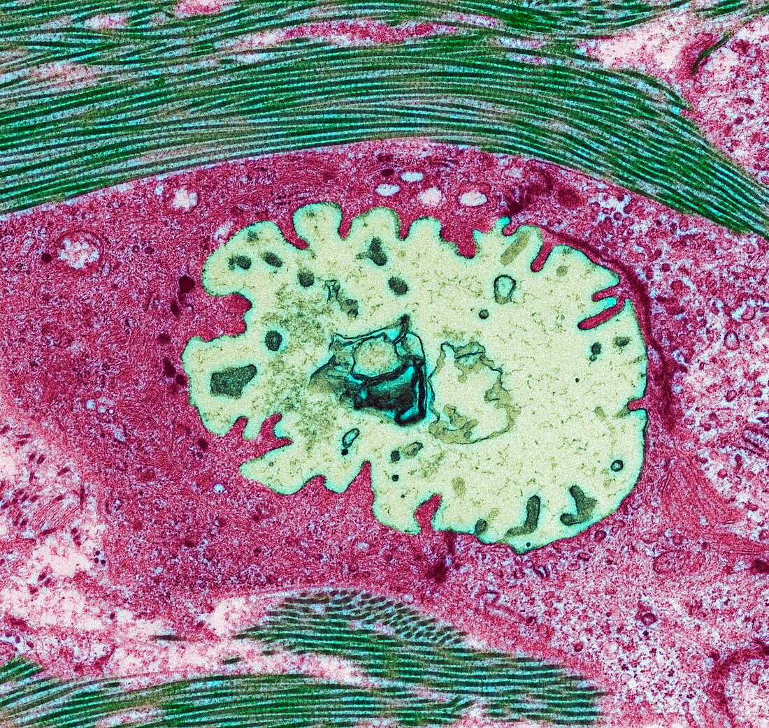 Breast cancer cell,TEM