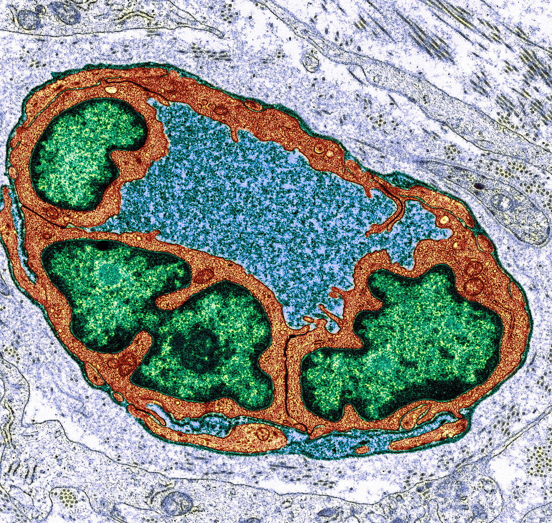 Capillary in breast cancer