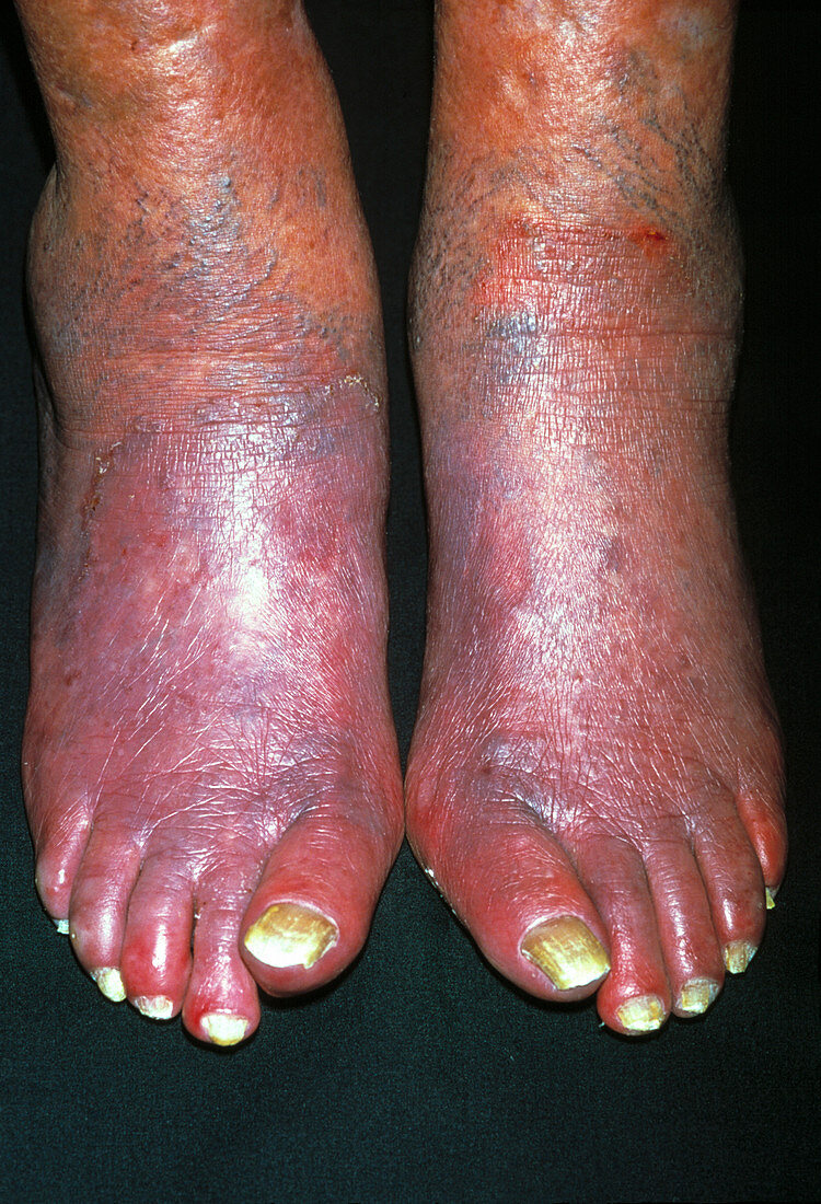 Cyanosis of the feet