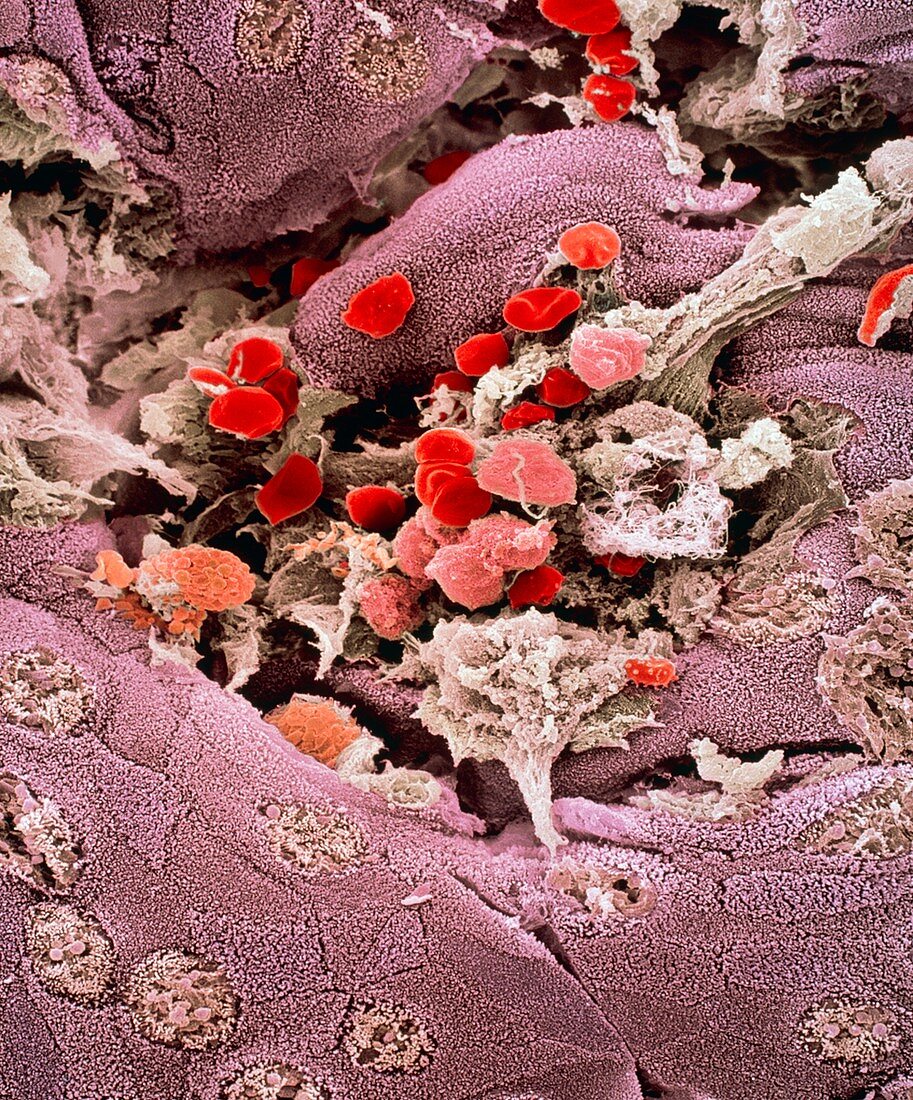 Ulcerative colitis,SEM