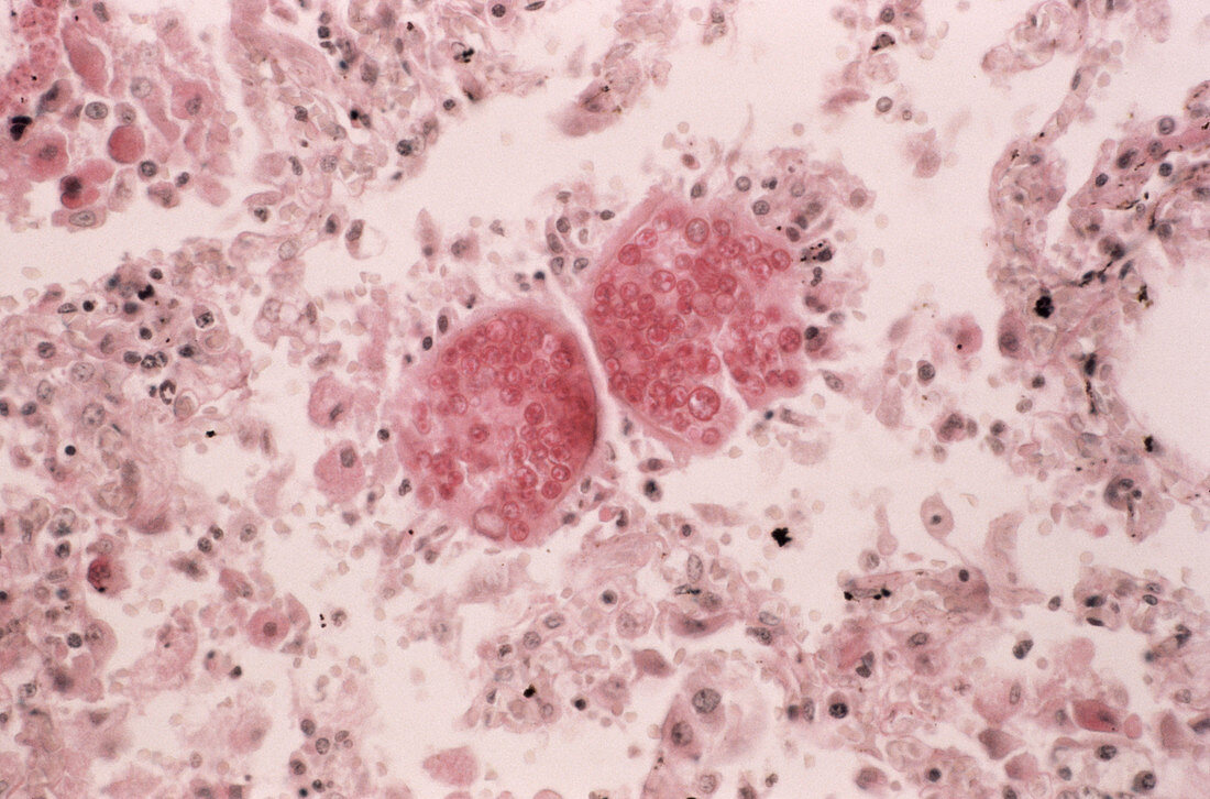 Fungal infection of the lung