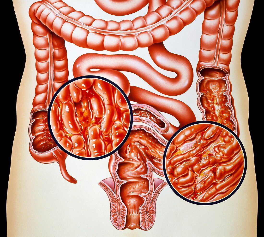 Ulcerative colitis