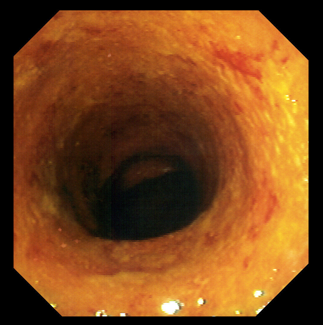 Ulcerative colitis