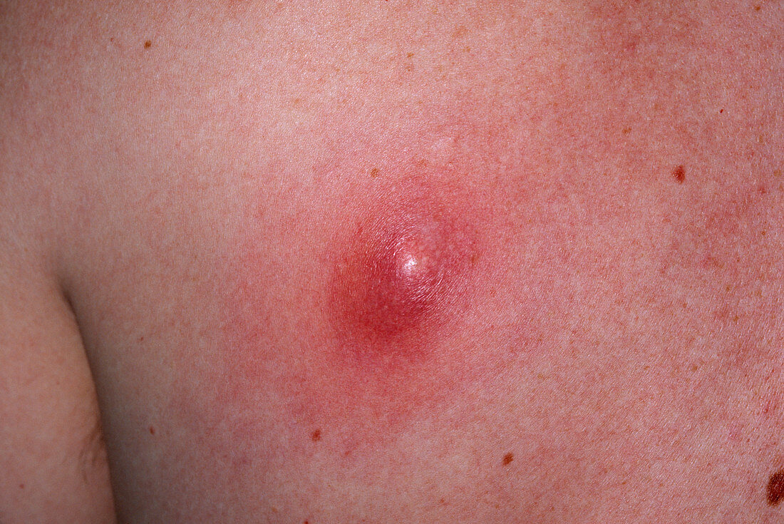 Infected sebaceous cyst