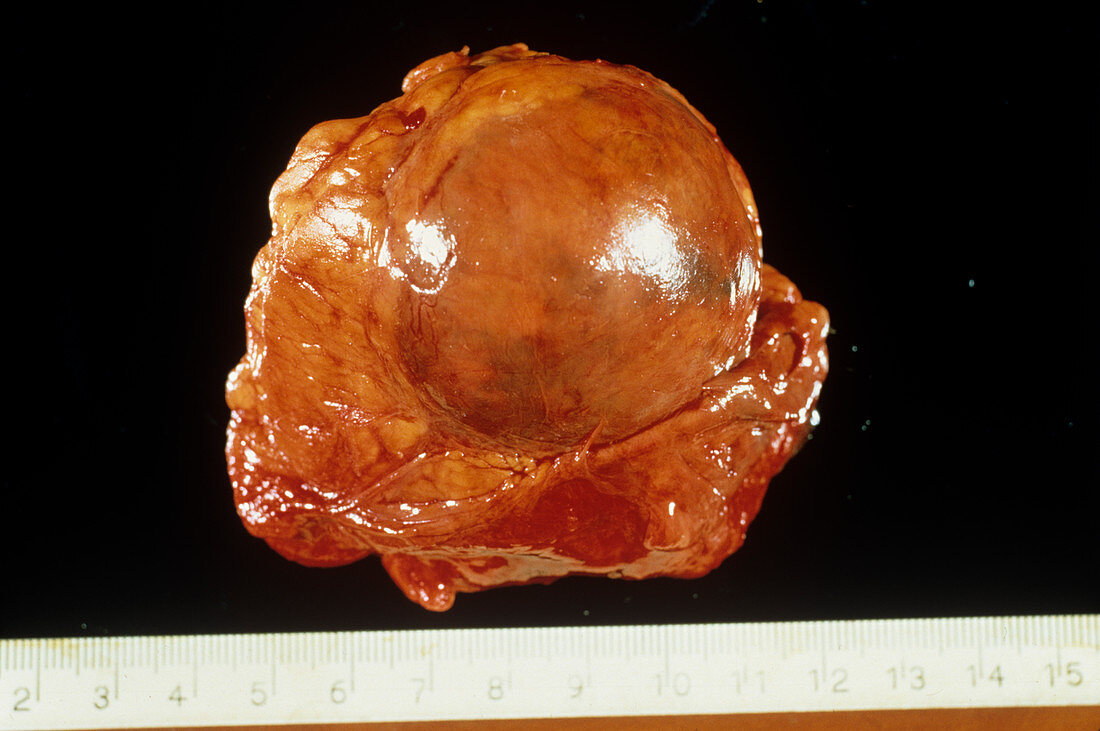 Blood-filled cyst from an adrenal gland