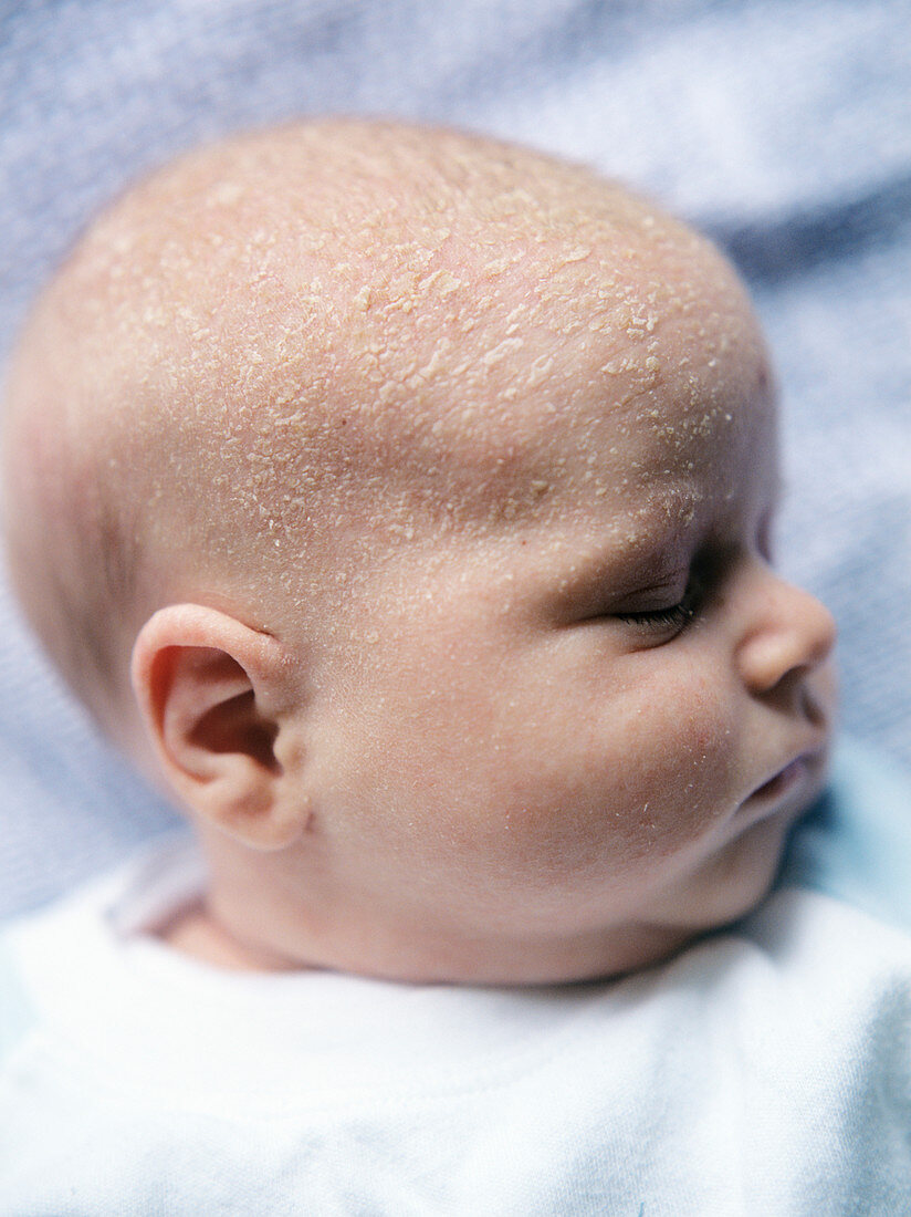 Cradle cap