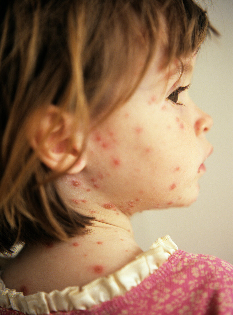 Chickenpox