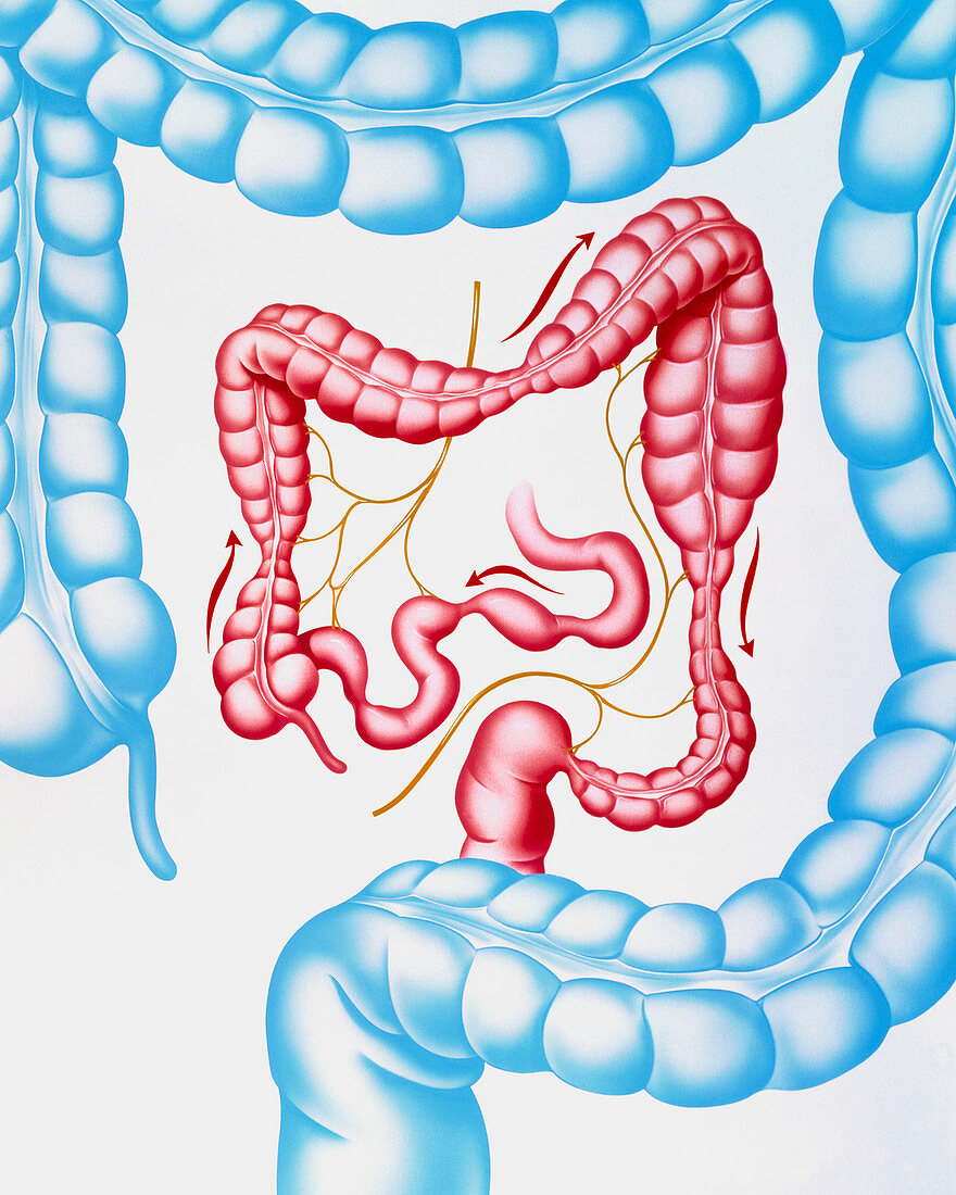 Artwork of irritable bowel syndrome & normal colon