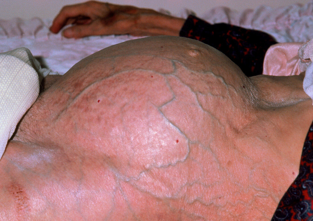 Swollen abdomen caused by constipation,geriatric
