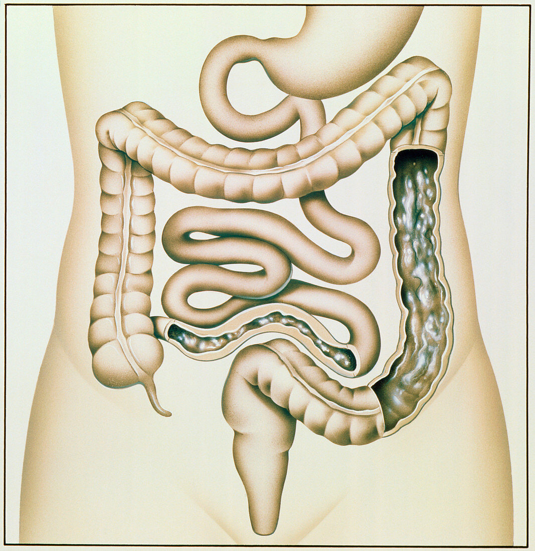 Artwork of Crohn's disease and ulcerative colitis