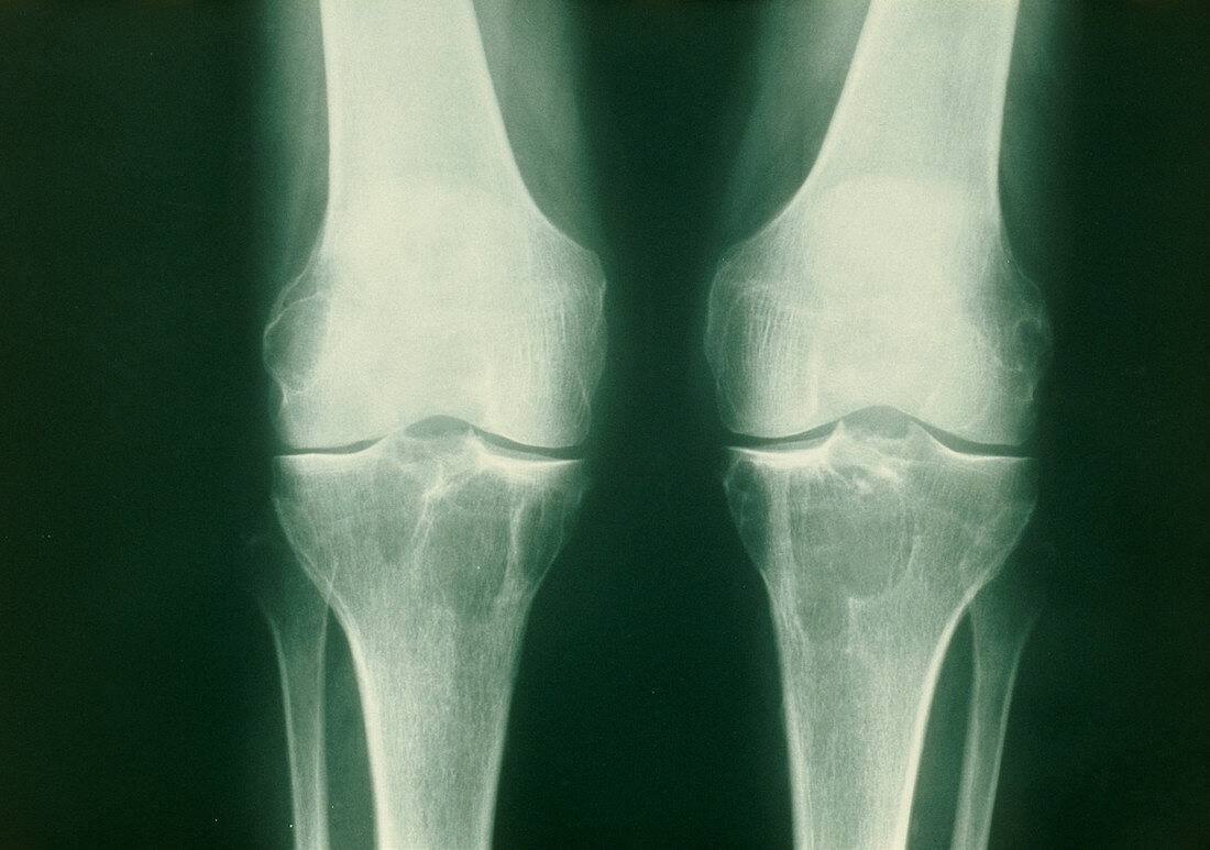 X-ray of knees with Baker's cysts