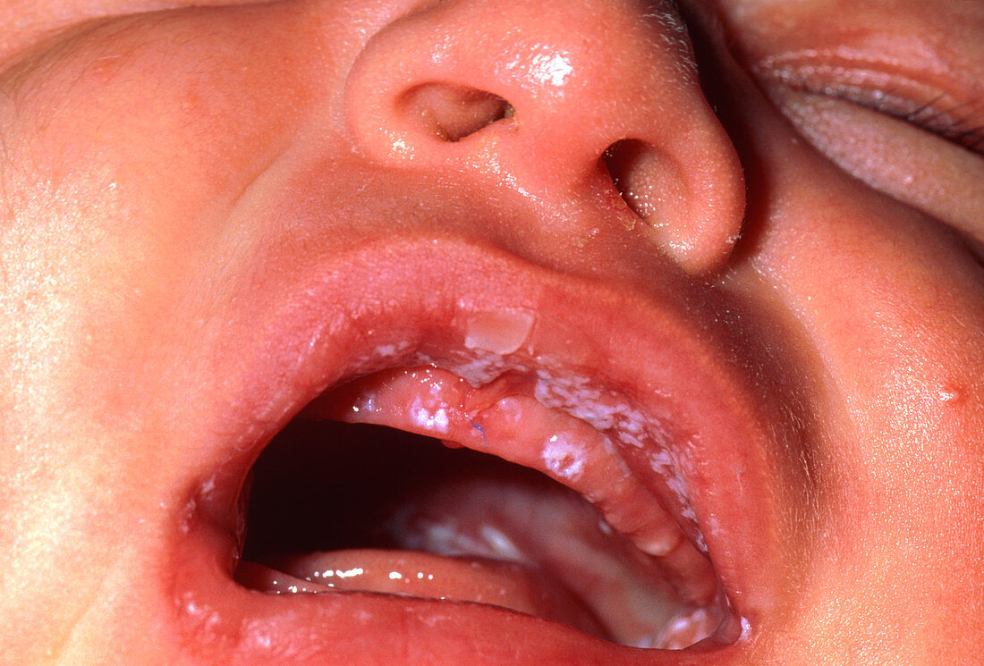Oral candidiasis (thrush) in a baby's mouth