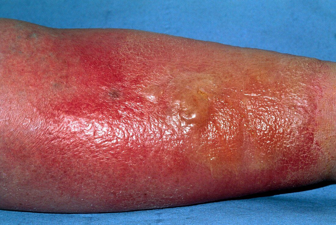Cellulitis on the leg of elderly woman