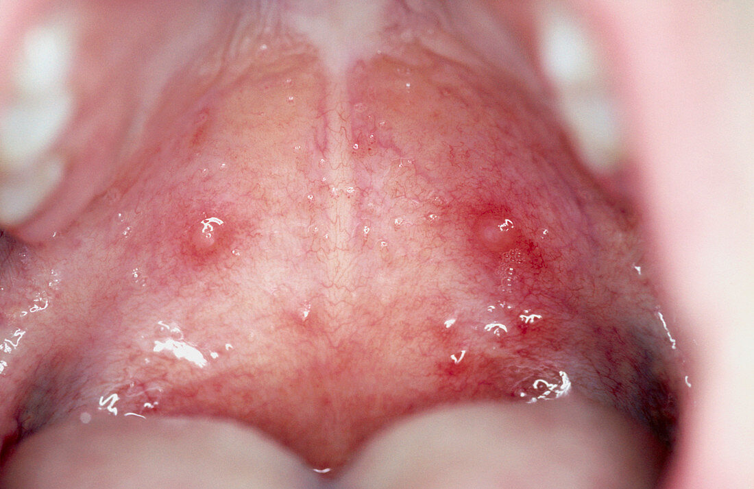 Chickenpox lesion in the mouth of a child