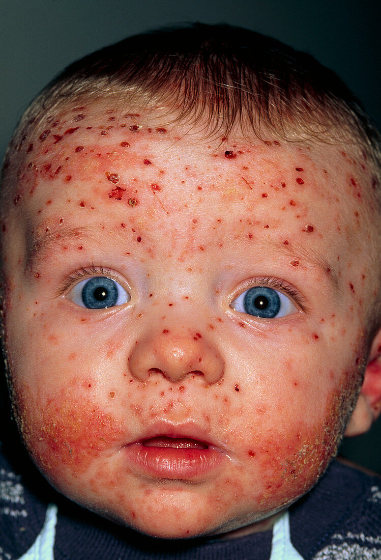 Chickenpox and eczema on the face of a baby boy