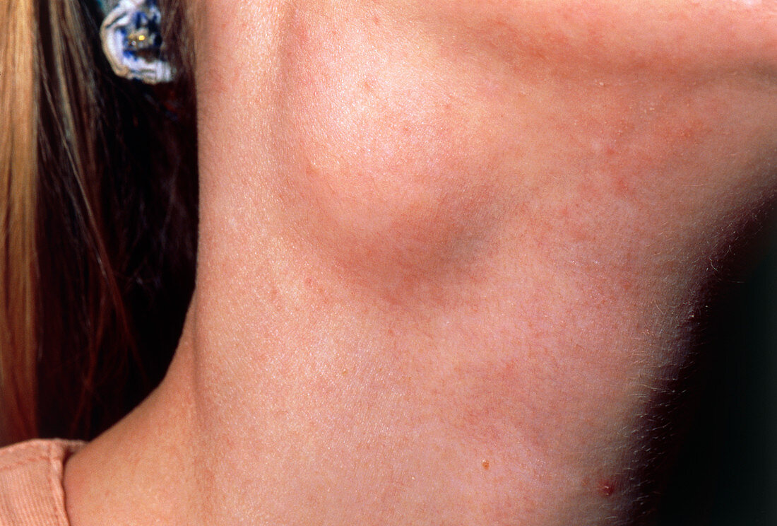 Close-up of a branchial cyst in neck of a woman